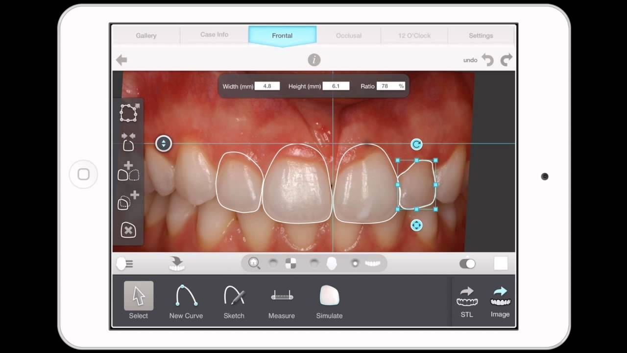 Cyfrowe planowanie leczenia implantologicznego — symulacja 3D na monitorze